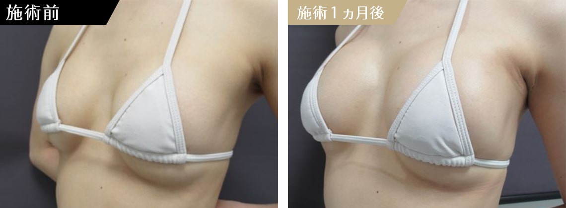CASE２ 他院人工乳腺バッグの修正