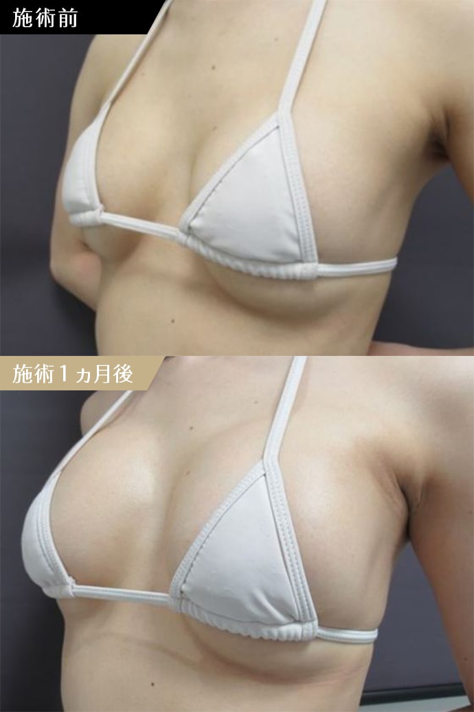 CASE２ 他院人工乳腺バッグの修正