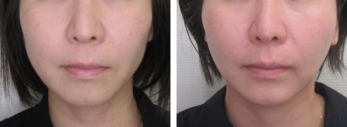 アゴ整形 大阪taクリニック ヒアルロン酸 プロテーゼ 費用 心斎橋のおすすめ美容整形 美容外科