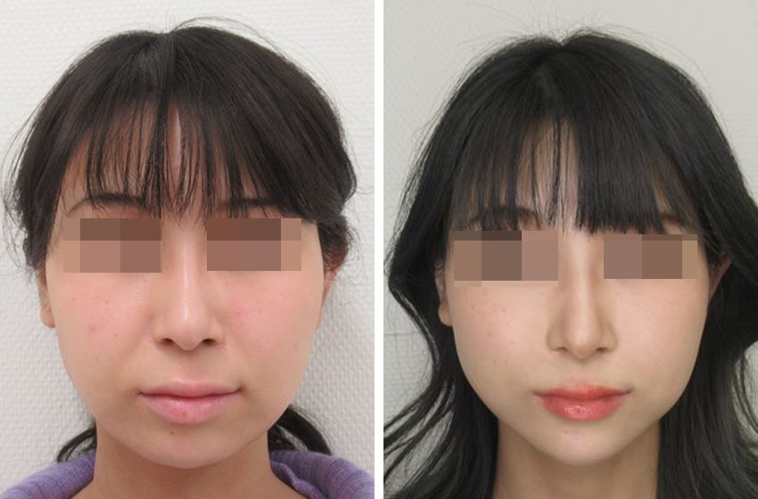 アゴ整形 大阪taクリニック ヒアルロン酸 プロテーゼ 費用 心斎橋のおすすめ美容整形 美容外科