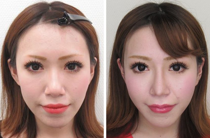 ボトックス ボツリヌストキシン注射 エラ 口角 ふくらはぎ 肩 目の下 脇汗に 効果と料金 心斎橋駅徒歩0分の美容外科 大阪taクリニック