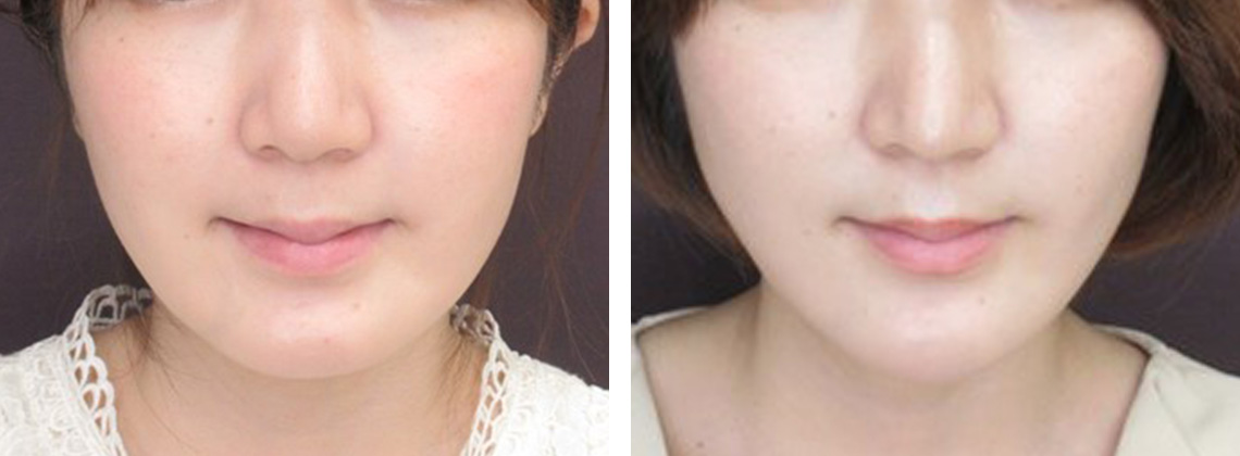 アゴ整形 大阪taクリニック ヒアルロン酸 プロテーゼ 費用 心斎橋のおすすめ美容整形 美容外科