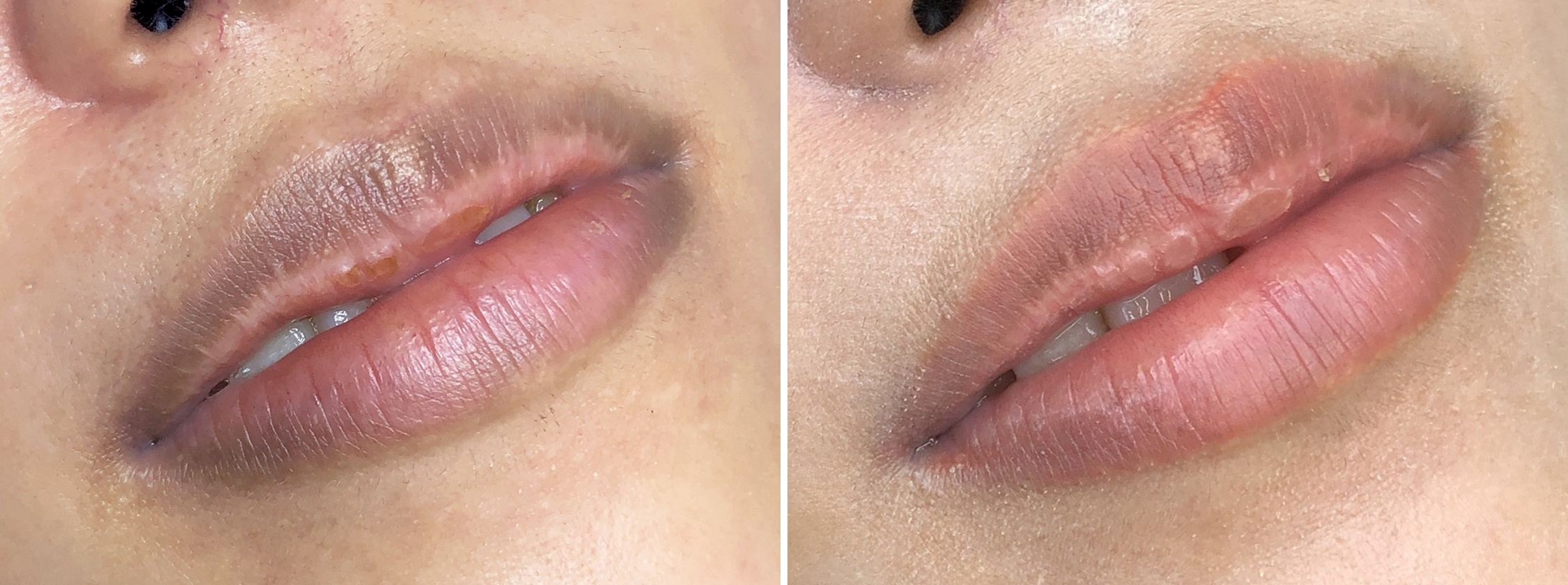 Tacメディカルアートメイク 眉 アイライン リップなら大阪taクリニック ダウンタイム 費用 効果 大阪taクリニック 大阪 心斎橋の美容整形 美容外科